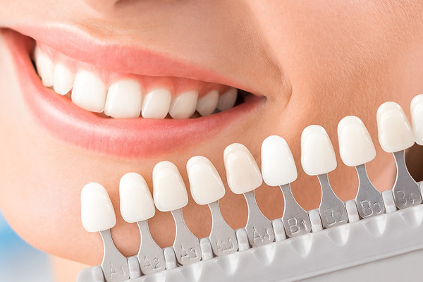 Gibt es Nebenwirkungen der Zahnaufhellung? Sie kennen diese drei Punkte nicht